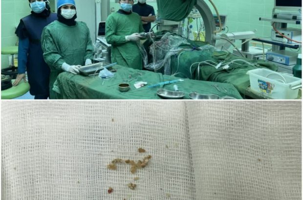 برای اولین بار در استان انجام شد؛  انجام عمل جراحی کلیه از طریق پوست در کودک سه ساله در بیمارستان امام رضا (ع) اردبیل
